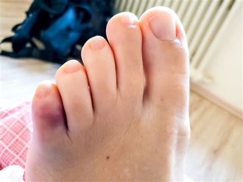 ayak serçe parmak kırığı nasıl iyileşir